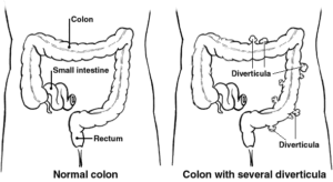 Comparison of a normal colon and a colon with diverticula